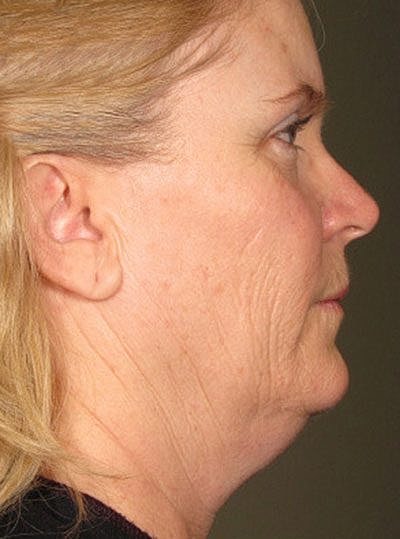 Cheek Fillerzz Before & After