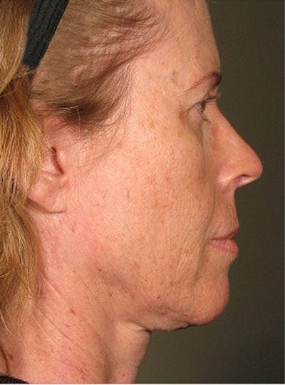 Cheek Fillerzz Before & After