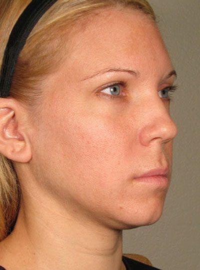 Cheek Fillerzz Before & After