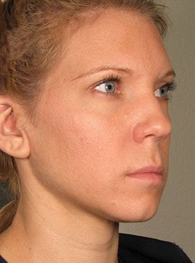 Cheek Fillerzz Before & After