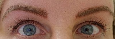 Cheek Fillerzz Before & After