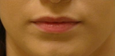 Cheek Fillerzz Before & After