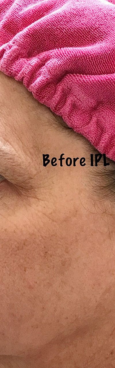 Cheek Fillerzz Before & After