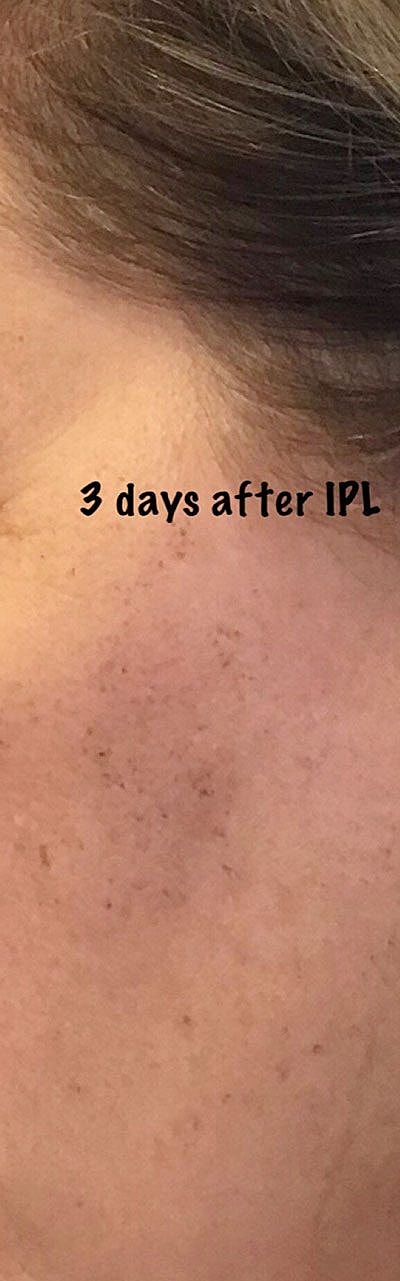 Cheek Fillerzz Before & After