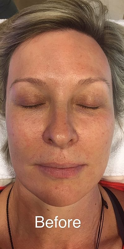 Cheek Fillerzz Before & After