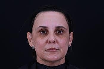 Botox Dysport2 Before & After