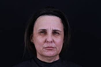 Botox Dysport2 Before & After