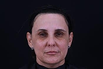 Botox Dysport2 Before & After