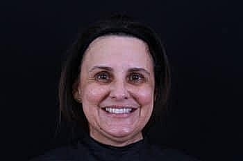 Botox Dysport5 Before & After