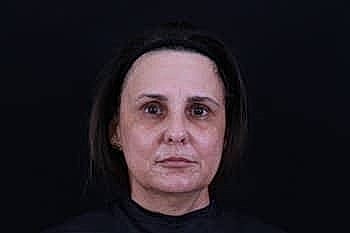 Botox Dysport4 Before & After